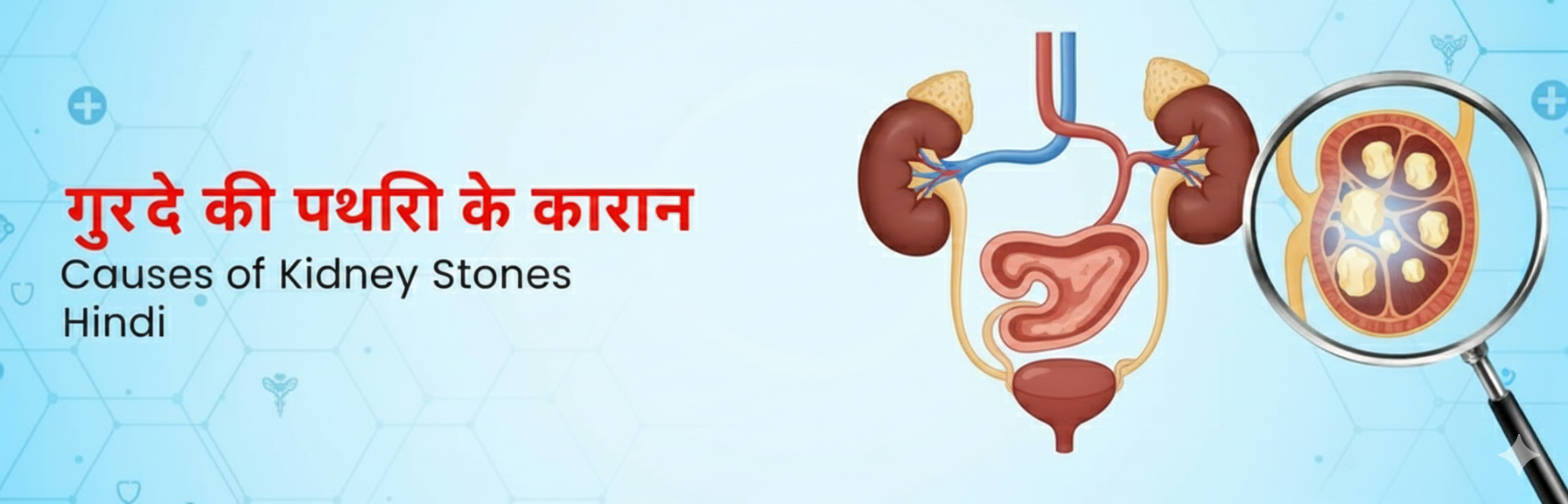 Causes of Kidney Stones in Hindi